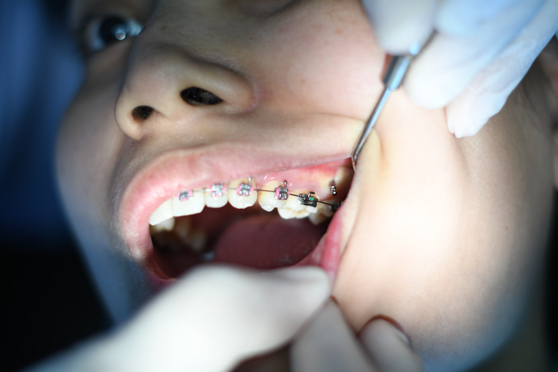 Invisalign over braces - Smyrna & Franklin Dentist
